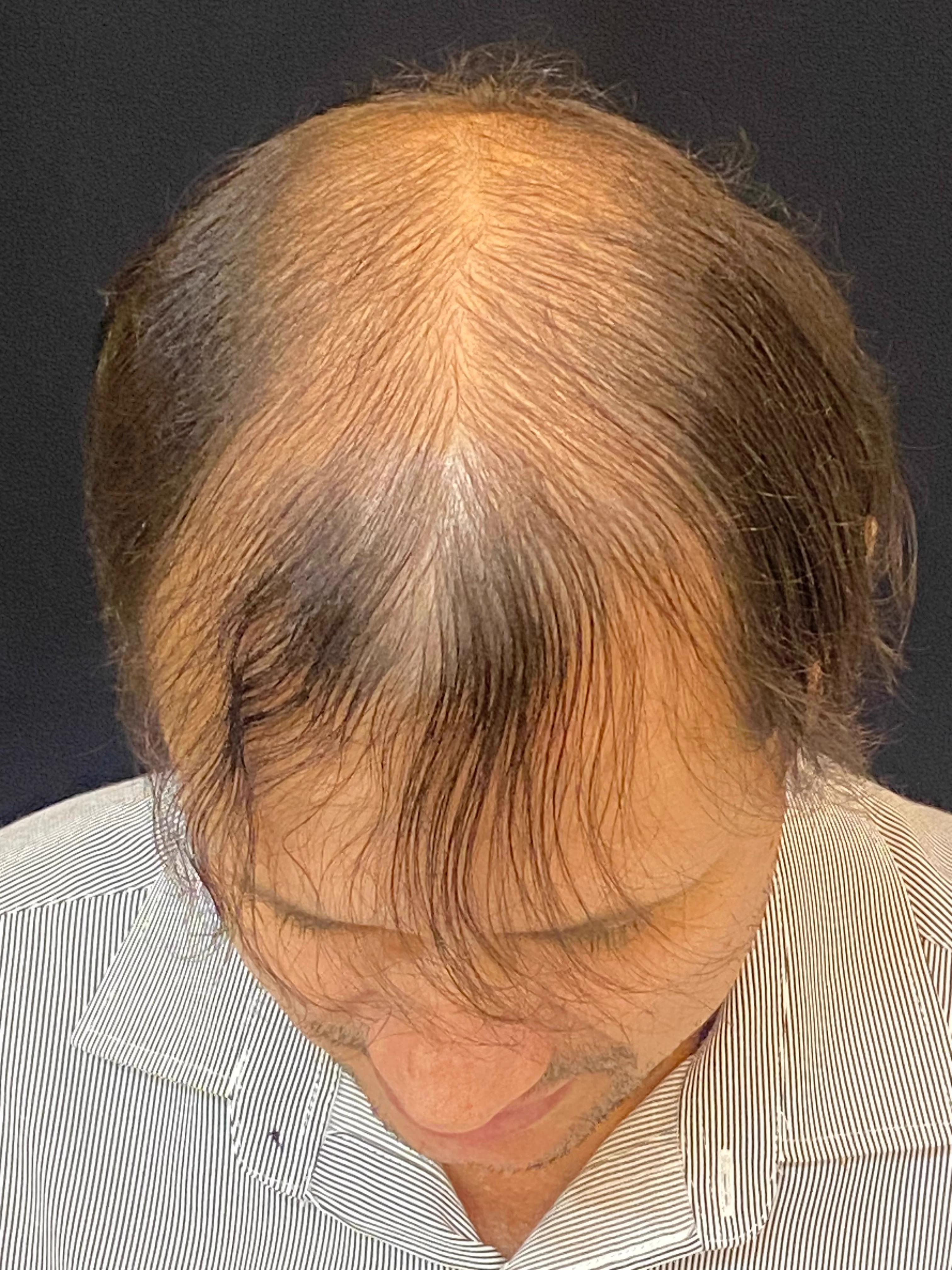 Antes do transplante capilar - resultado 1