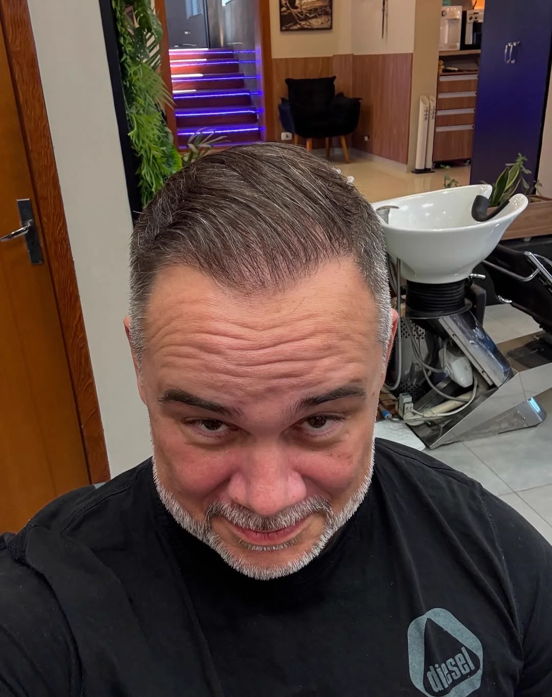 Depois do transplante capilar - resultado 2