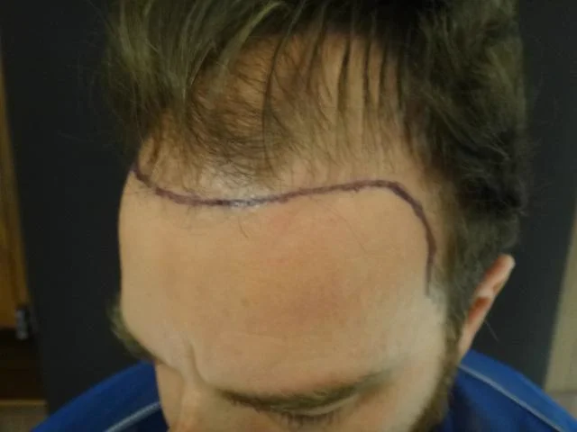 Antes do transplante capilar - resultado 4